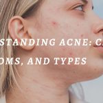 Understanding Acne: Causes, Symptoms, And Types