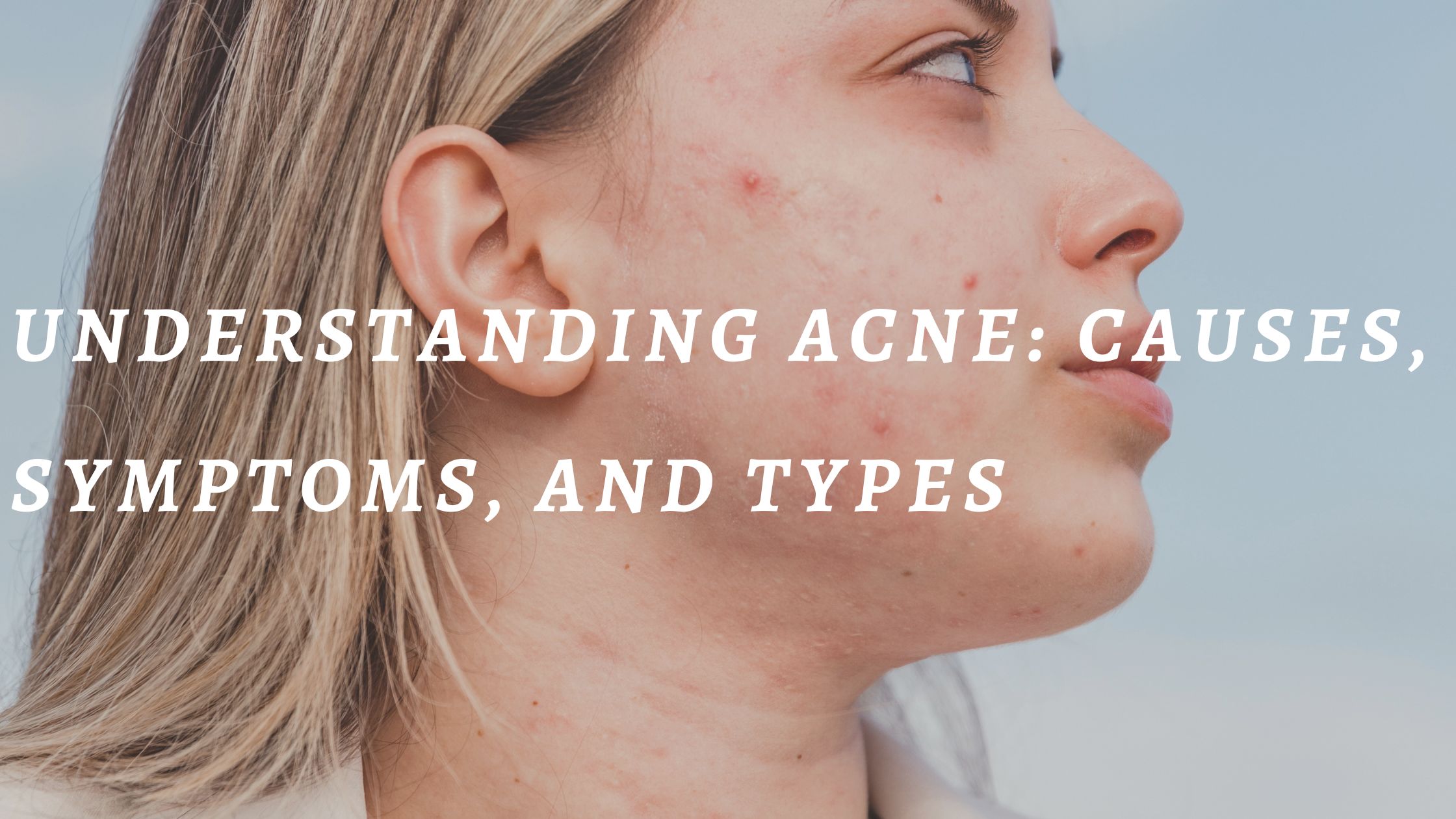 You are currently viewing Understanding Acne: Causes, Symptoms, And Types