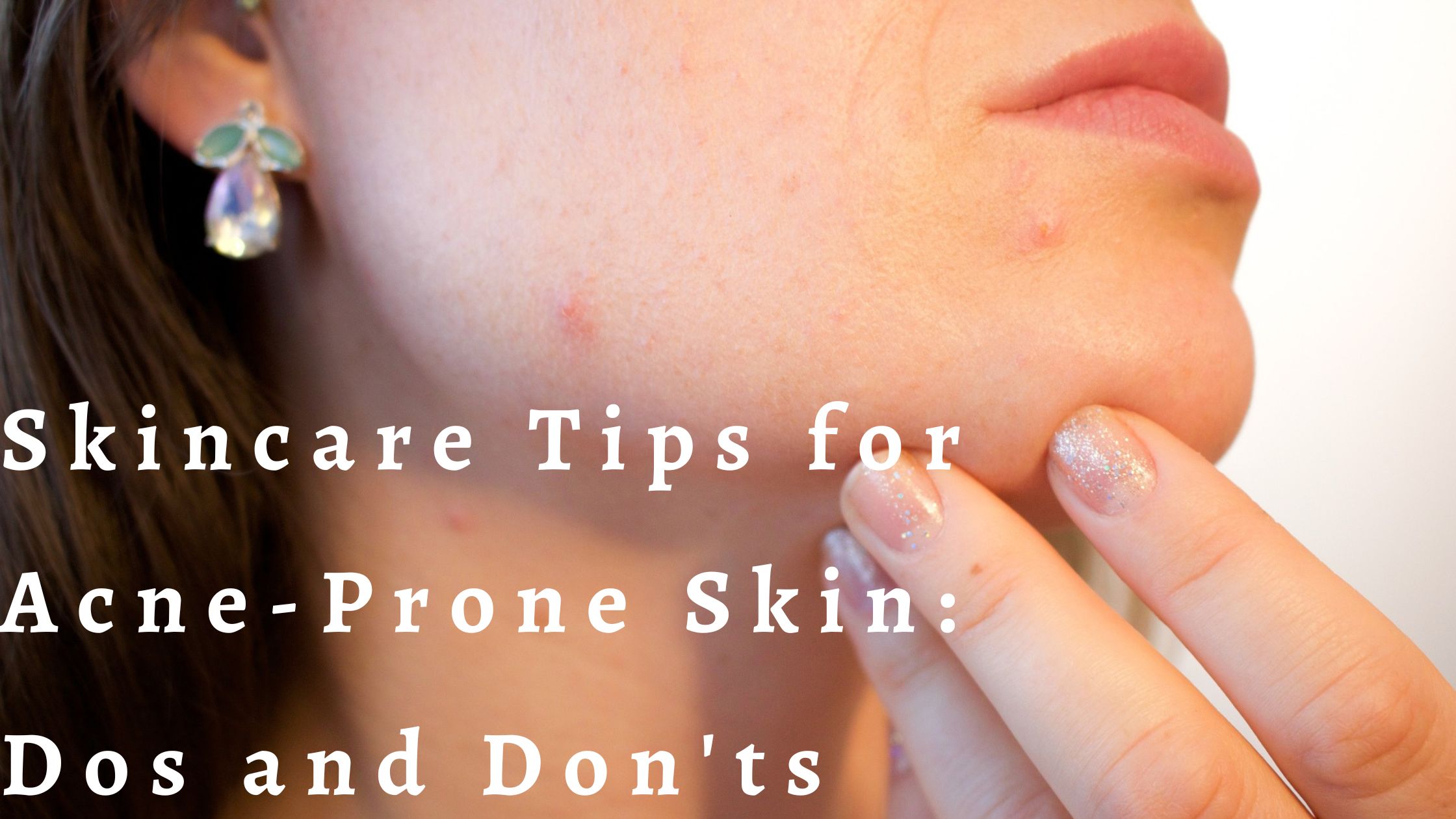 You are currently viewing Skincare Tips for Acne-Prone Skin: Dos and Don’ts