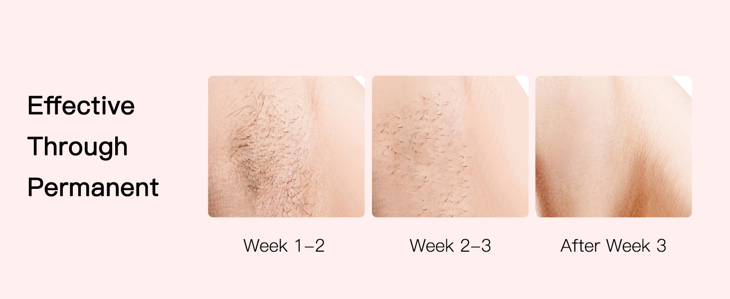 BoSidin IPL hair removal device functions and intended benefits.